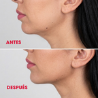 Masajeador Facial Elimina papada y arrugas